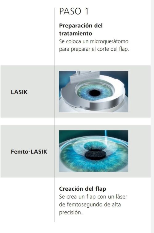 Modificar página actual diferencia cirugia refractiva tecnica lasik vs Femto Lasik